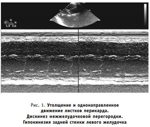 Утолщение и однонаправленное движение листков перикарда. Дискинез межжелудочковой перегородки. Гипокинезия задней стенки левого желудочка