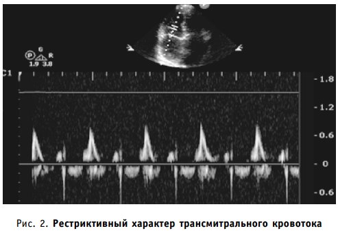 Рестриктивный характер трансмитрального кровотока