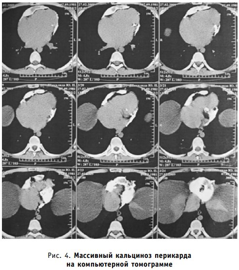Массивный кальциноз перикарда на компьютерной томограмме