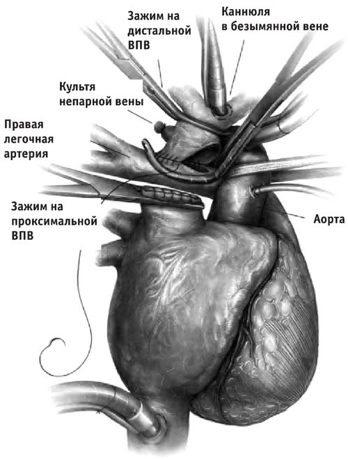 Выполнение двунаправленного анастомоза Гленна