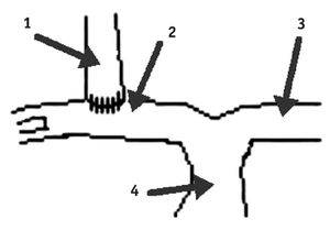 Схема двунаправленного анастомоза Гленна