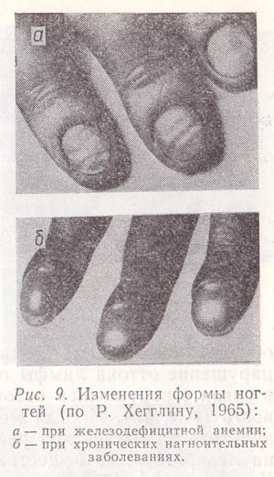 Изменения формы ногтей при железодефицитной анемии и при хронических нагноительных заболеваниях