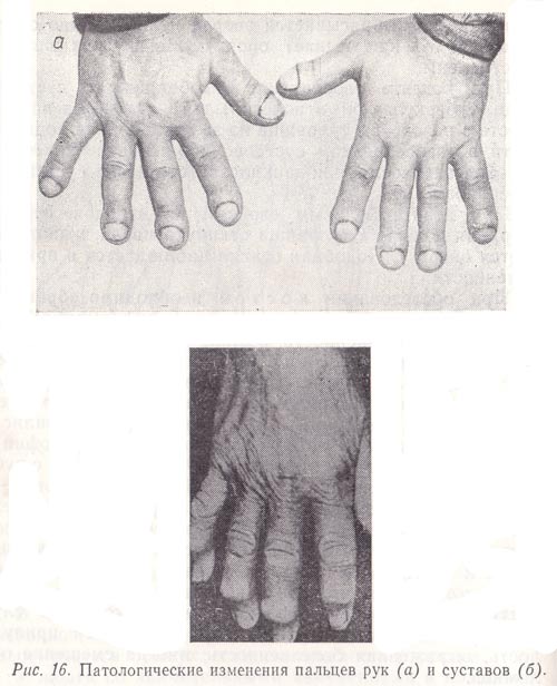 Патологические изменения пальцев рук