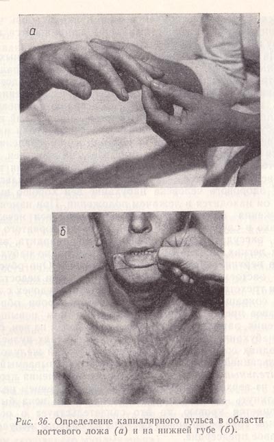 Определение капиллярного пульса в области ногтевого ложа и на нижней губе