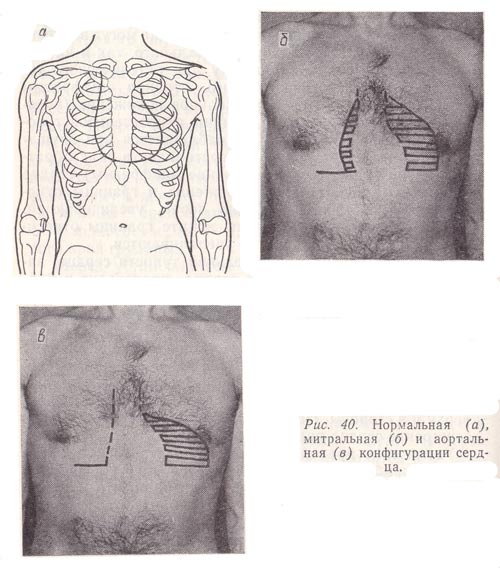 Нормальная, митральная и аортальная конфигурации сердца