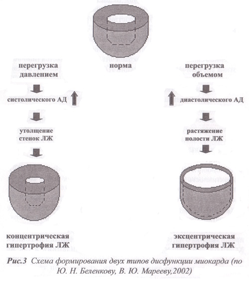 схема формирования двух типов дисфункции миокарда (по Ю. П. Беленкову, В. Ю. Марееву, 2002)