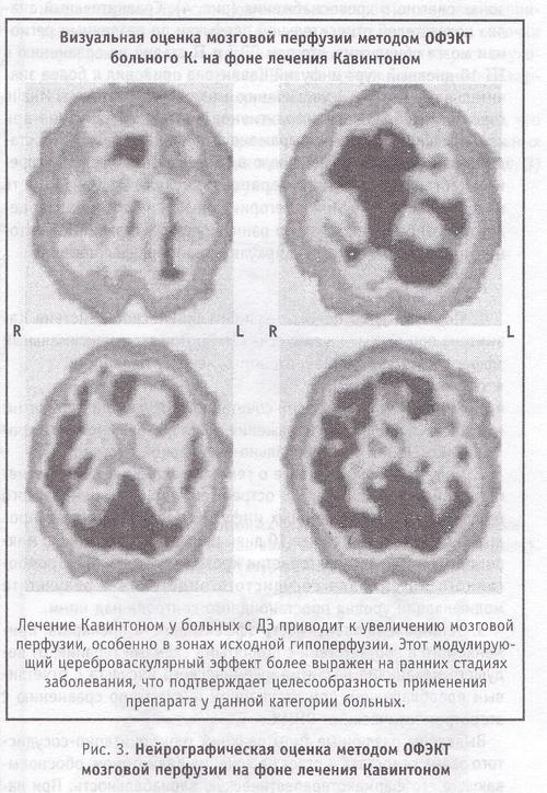 Нейрографическая оценка методом ОФЭКТ мозговой перфузии на фоне лечения Кавинтоном