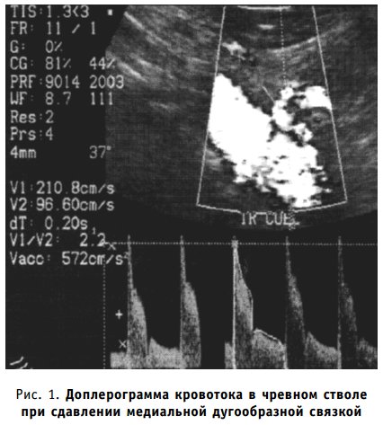 Доплерограмма кровотока в чревном стволе при сдавлении медиальной дугообразной связкой