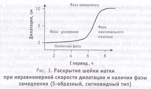 раскрытие шейки матки при неравномерной скорости дилатации и наличии фазы замедления (S-образный, сигмовидный тип)