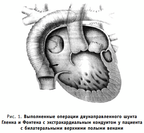 Выполненные операции двунаправленного шунта Гленна и Фонтена с экстракардиальным кондуитом у пациента с билатеральными верхними полыми венами