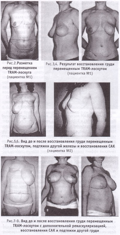 вид до и после восстановления груди