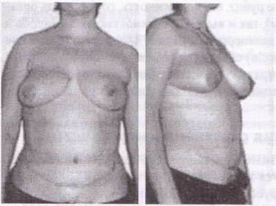 вид до и после восстановления груди свободным TRAM-лоскутом и подтяжки другой груди